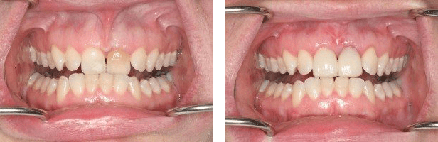 labial-frenum-before-and-after-1 labial-frenum-before-and-after-1