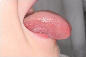 lingual-frenectomy-after lingual-frenectomy-after