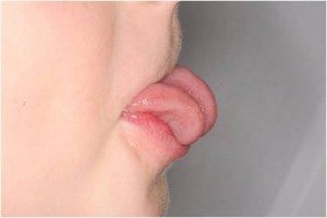 lingual-frenectomy_before