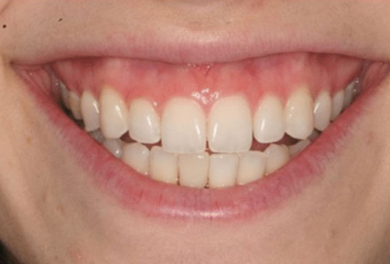 lip_repositioning-01-before lip_repositioning-01-before