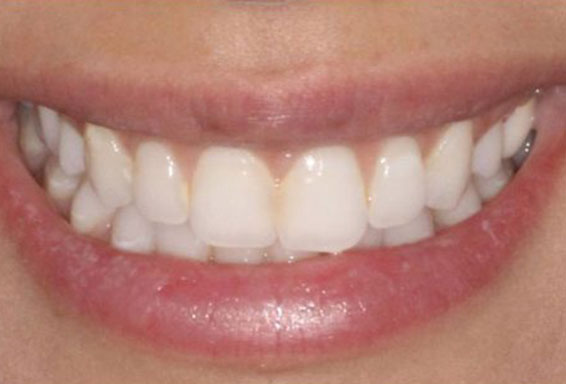 lip_repositioning-04-afterjpg lip_repositioning-04-afterjpg