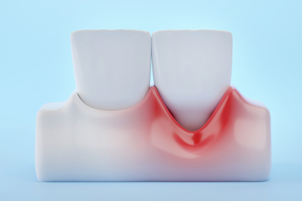how to improve gum recession