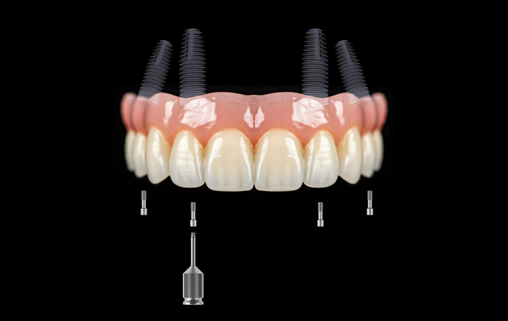 dental implants detroit